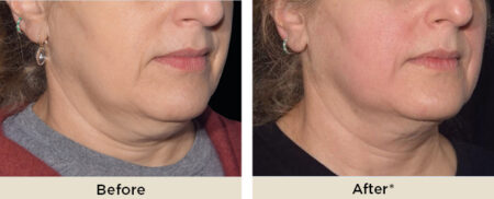 EMsculpt before and after
